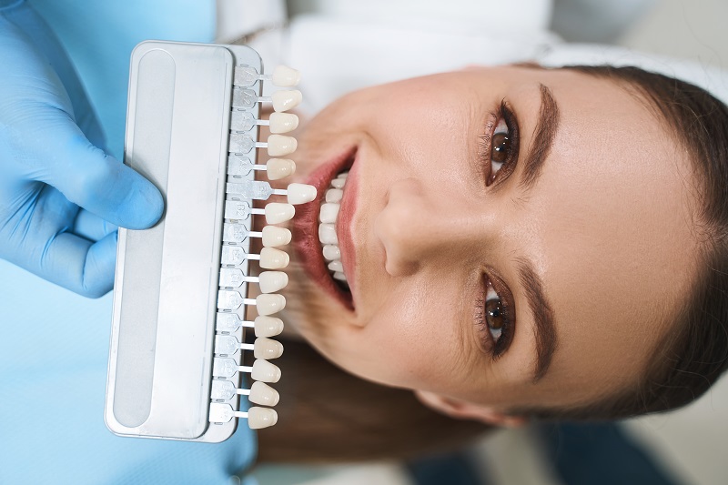 Descubre lo que necesitas saber sobre las carillas dentales